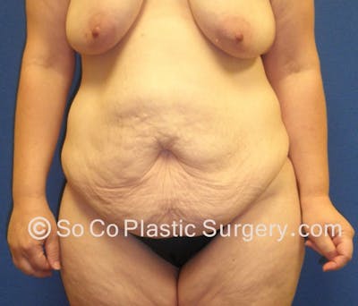 Tummy Tuck Before & After Gallery - Patient 8286186 - Image 1
