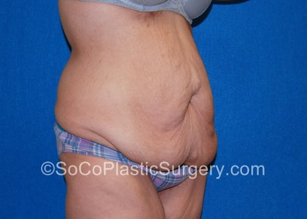 Tummy Tuck Before & After Gallery - Patient 8286187 - Image 3