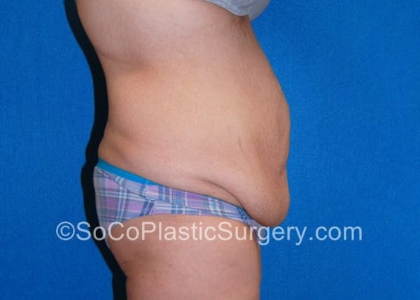 Tummy Tuck Before & After Gallery - Patient 8286187 - Image 5