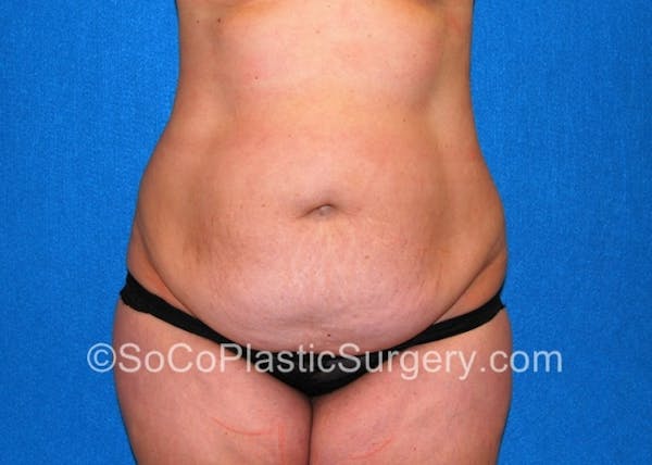 Tummy Tuck Before & After Gallery - Patient 8286188 - Image 3