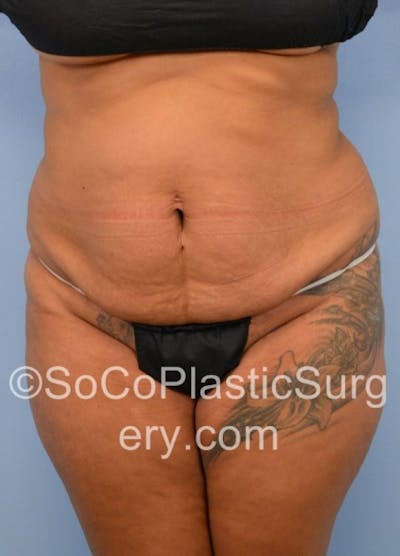 Tummy Tuck Before & After Gallery - Patient 8286189 - Image 1