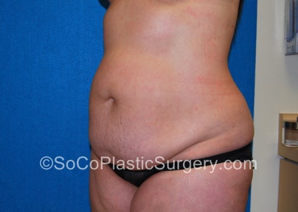 Tummy Tuck Before & After Gallery - Patient 8286188 - Image 5