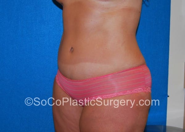 Tummy Tuck Before & After Gallery - Patient 8286188 - Image 6