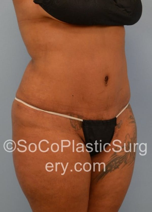 Tummy Tuck Before & After Gallery - Patient 8286189 - Image 4