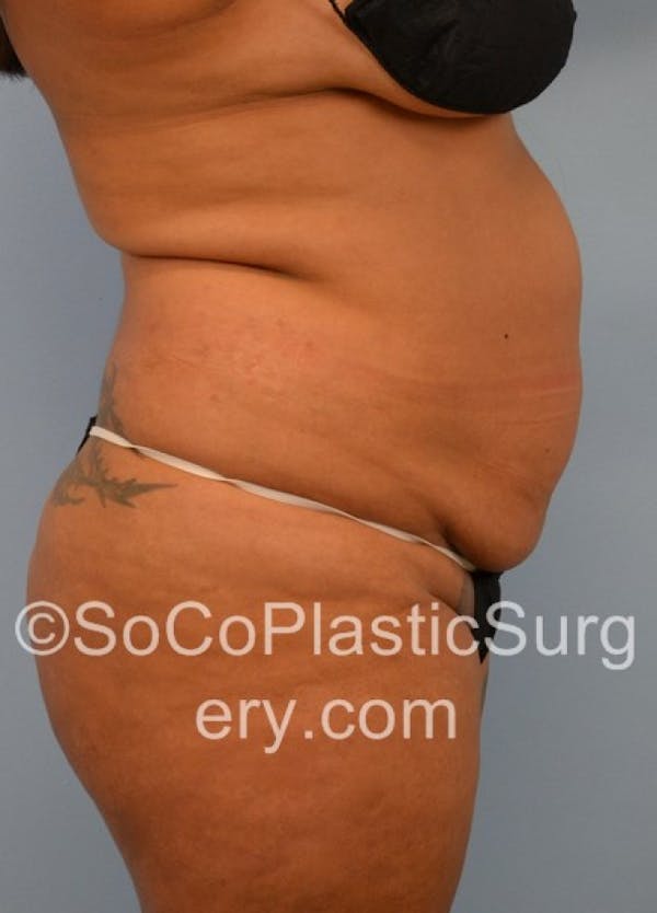 Tummy Tuck Before & After Gallery - Patient 8286189 - Image 5