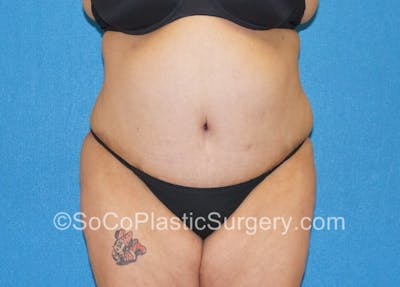 Tummy Tuck Before & After Gallery - Patient 8286191 - Image 2