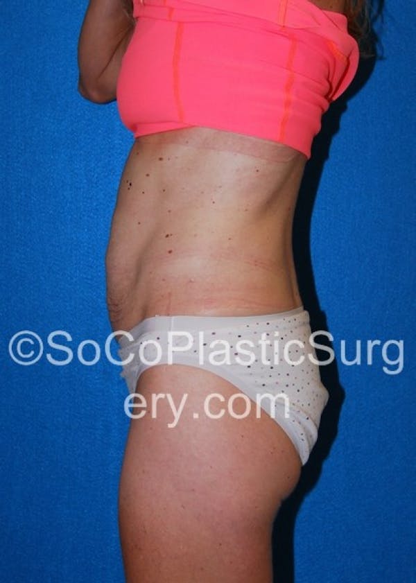 Tummy Tuck Before & After Gallery - Patient 8286190 - Image 5
