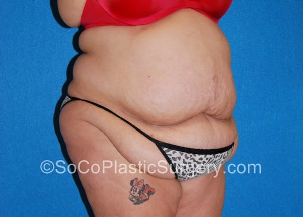 Tummy Tuck Before & After Gallery - Patient 8286191 - Image 3