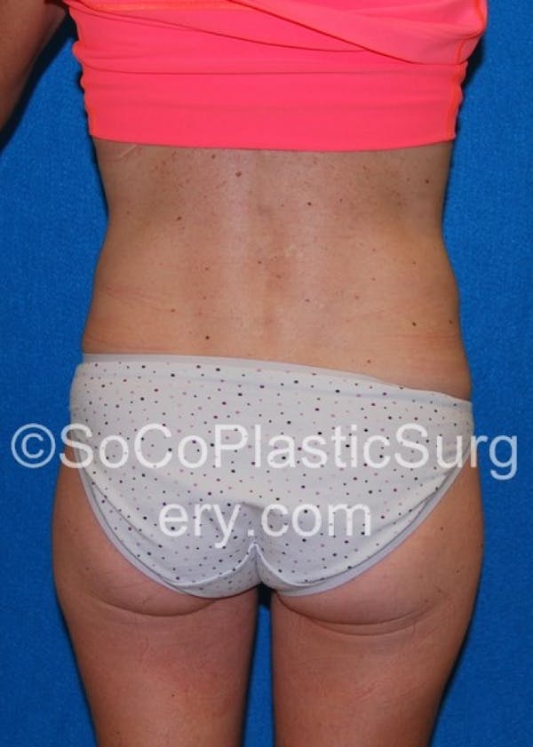 Tummy Tuck Before & After Gallery - Patient 8286190 - Image 7