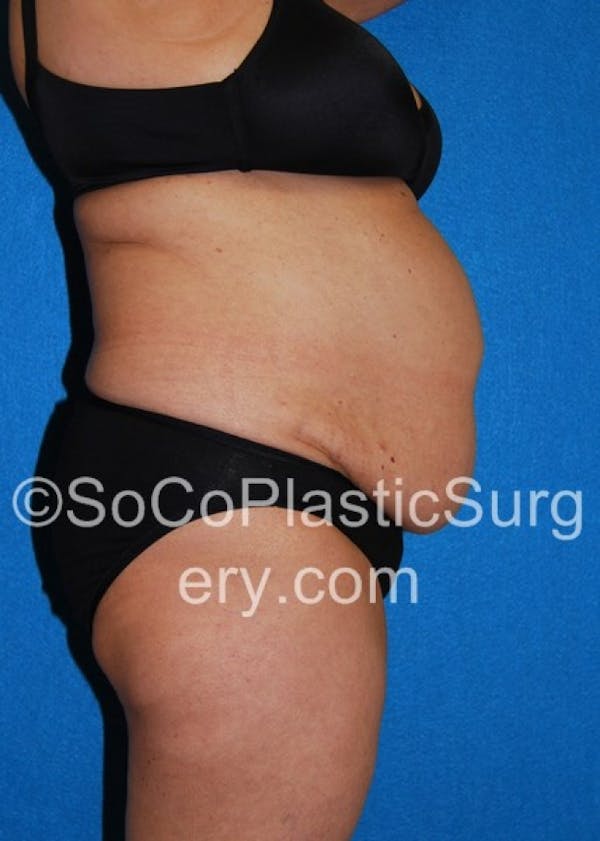 Tummy Tuck Before & After Gallery - Patient 8286192 - Image 5