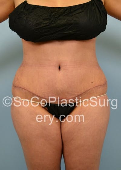 Tummy Tuck Before & After Gallery - Patient 8286196 - Image 2