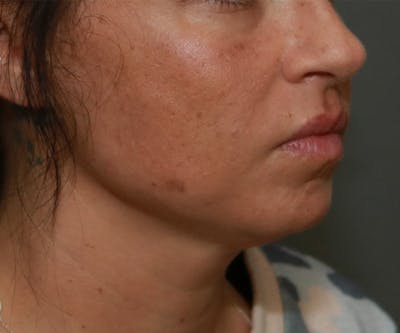 Double Chin (Submental Liposuction) Before & After Gallery - Patient 14777982 - Image 1