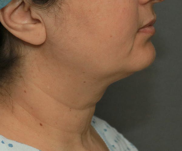 Double Chin (Submental Liposuction) Before & After Gallery - Patient 14777983 - Image 3