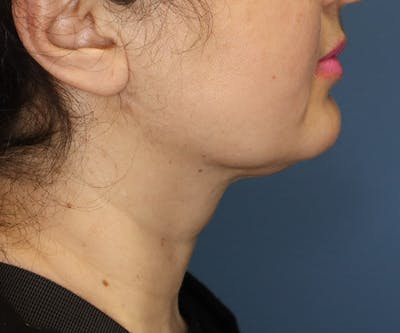 Double Chin (Submental Liposuction) Before & After Gallery - Patient 14777983 - Image 4