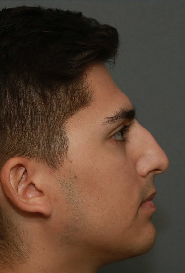 Revision Rhinoplasty Before & After Gallery - Patient 15239501 - Image 5