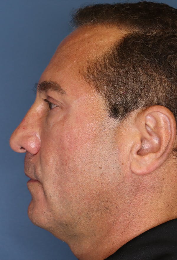Revision Rhinoplasty Before & After Gallery - Patient 18427125 - Image 5