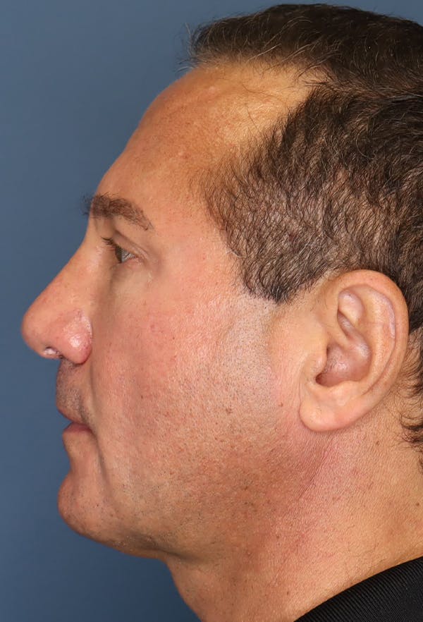 Revision Rhinoplasty Before & After Gallery - Patient 18427125 - Image 6
