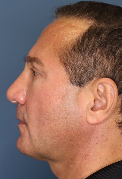 Revision Rhinoplasty Before & After Gallery - Patient 18427125 - Image 6