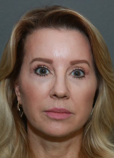 Facelift Before & After Gallery - Patient 21364537 - Image 2