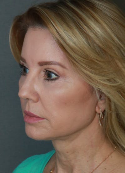 Facelift Before & After Gallery - Patient 21364537 - Image 6