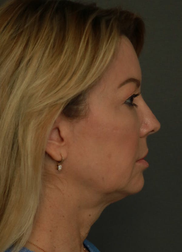 Facelift Before & After Gallery - Patient 21364537 - Image 7