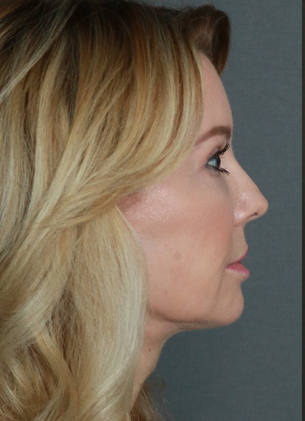 Facelift Before & After Gallery - Patient 21364537 - Image 8