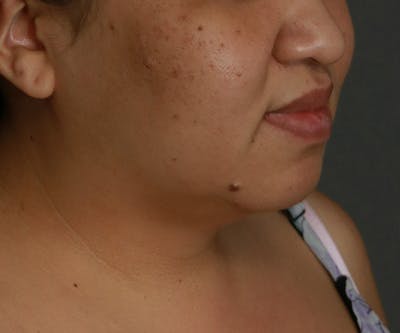 Double Chin (Submental Liposuction) Before & After Gallery - Patient 25775852 - Image 1