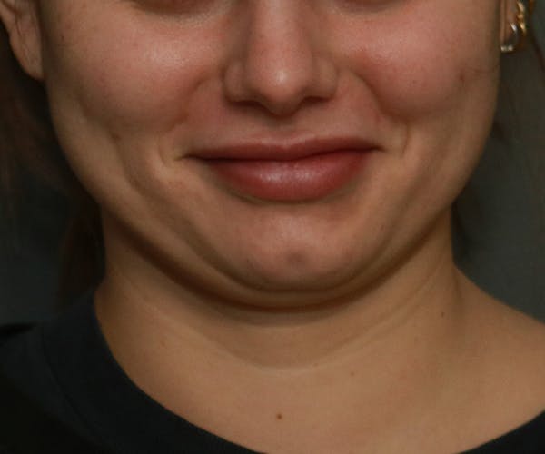 Double Chin (Submental Liposuction) Before & After Gallery - Patient 25775850 - Image 5
