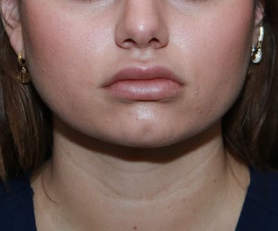 Double Chin (Submental Liposuction) Before & After Gallery - Patient 25775850 - Image 6