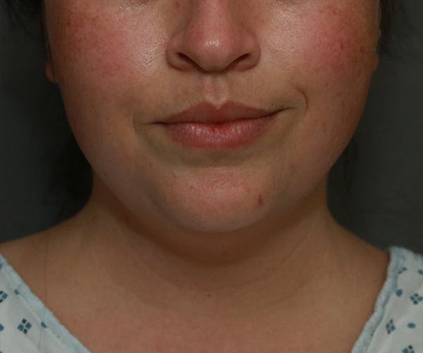 Double Chin (Submental Liposuction) Before & After Gallery - Patient 25775851 - Image 5