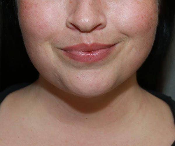 Double Chin (Submental Liposuction) Before & After Gallery - Patient 25775851 - Image 6