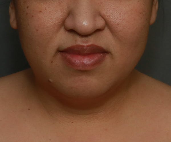 Double Chin (Submental Liposuction) Before & After Gallery - Patient 25775852 - Image 5