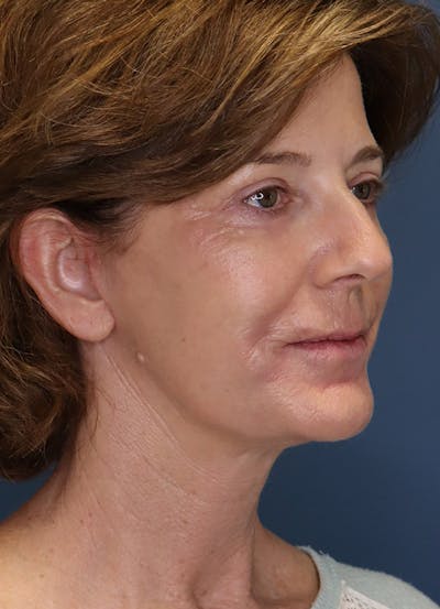 Facelift Before & After Gallery - Patient 31730255 - Image 8