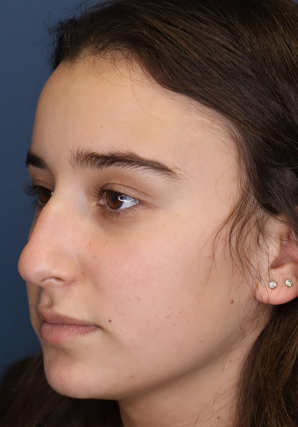 Aesthetic Rhinoplasty Before & After Gallery - Patient 31730263 - Image 3