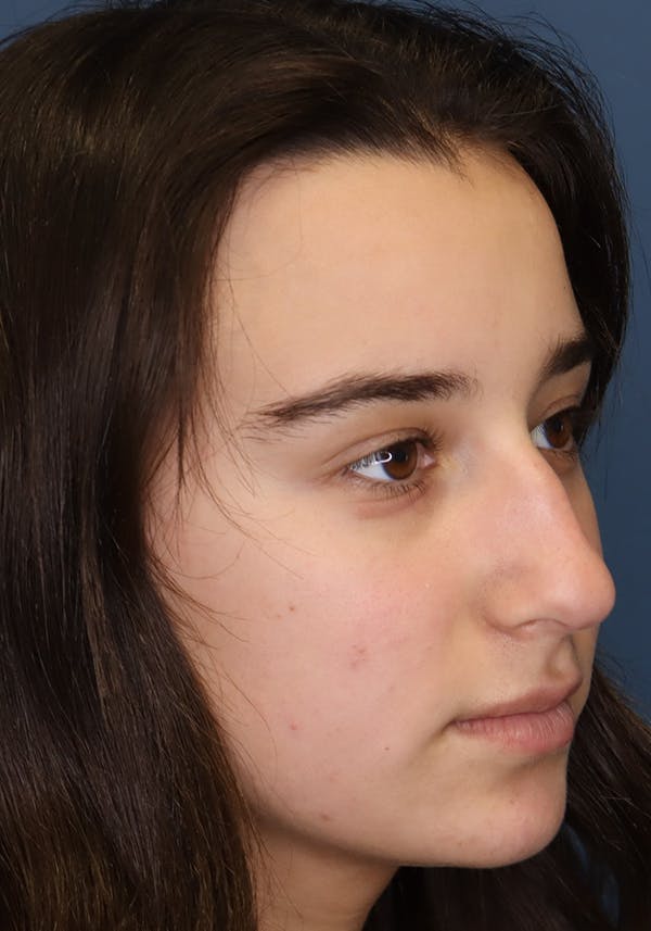 Aesthetic Rhinoplasty Before & After Gallery - Patient 31730263 - Image 7