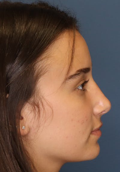 Aesthetic Rhinoplasty Before & After Gallery - Patient 31730263 - Image 10
