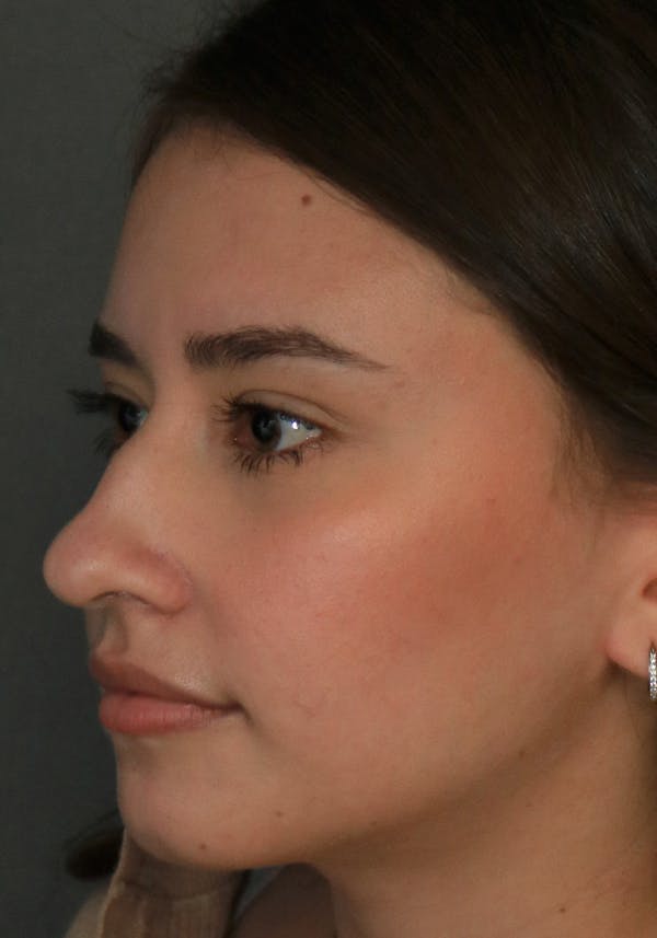 Aesthetic Rhinoplasty Before & After Gallery - Patient 32588683 - Image 3