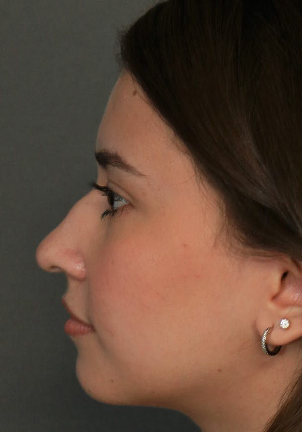 Aesthetic Rhinoplasty Before & After Gallery - Patient 32588683 - Image 5