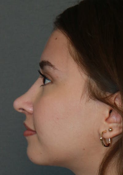 Aesthetic Rhinoplasty Before & After Gallery - Patient 32588683 - Image 6