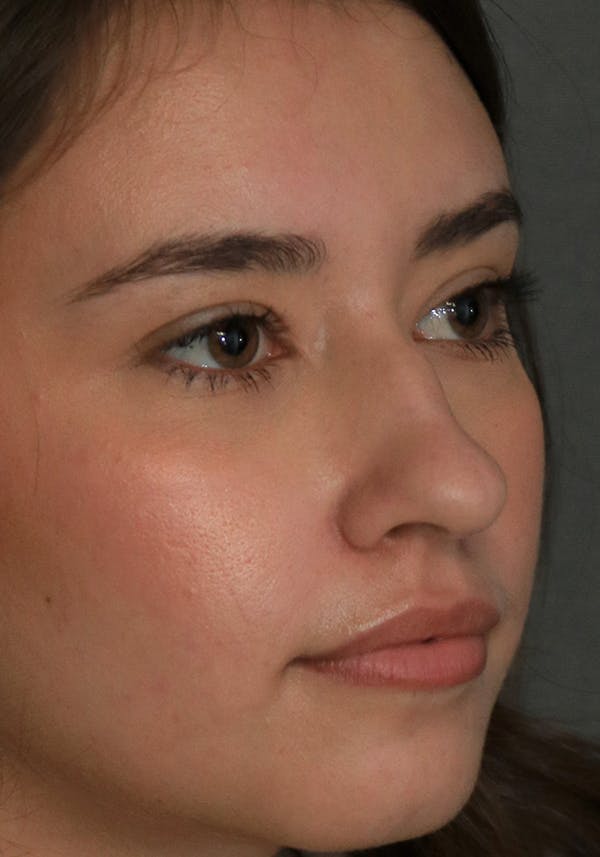 Aesthetic Rhinoplasty Before & After Gallery - Patient 32588683 - Image 7