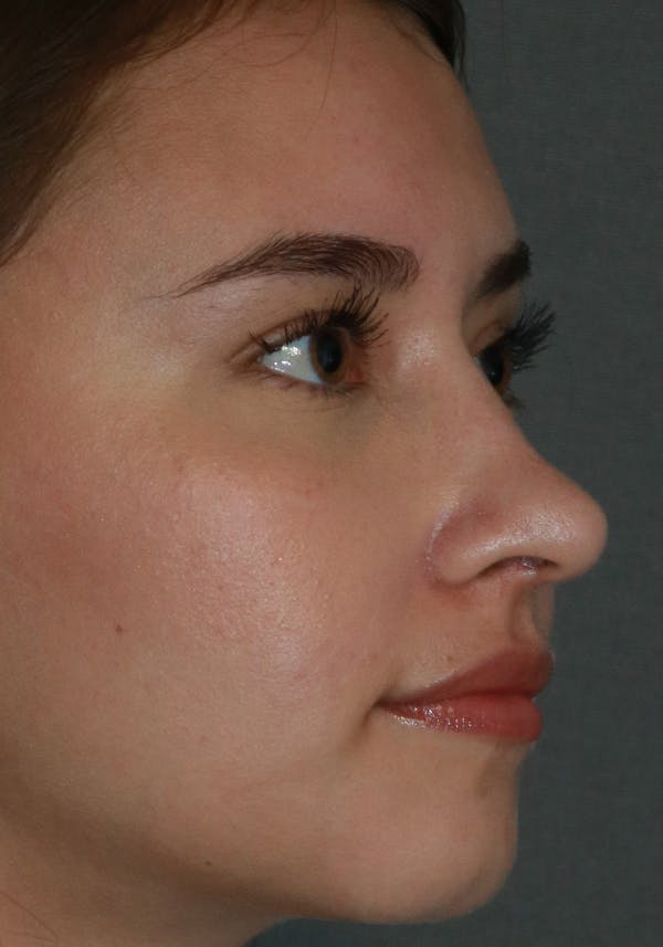Aesthetic Rhinoplasty Before & After Gallery - Patient 32588683 - Image 8