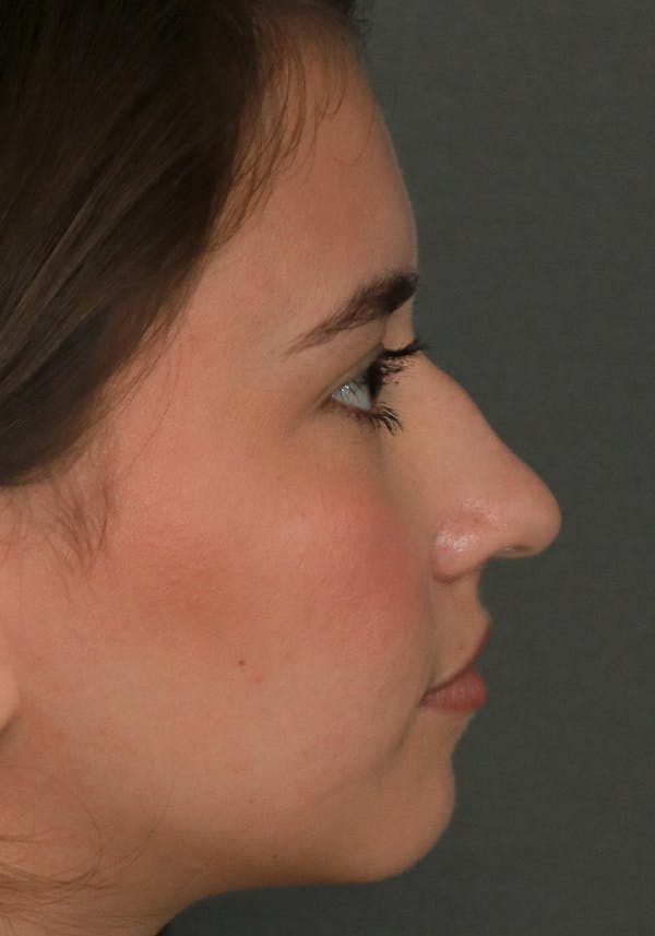Aesthetic Rhinoplasty Before & After Gallery - Patient 32588683 - Image 9