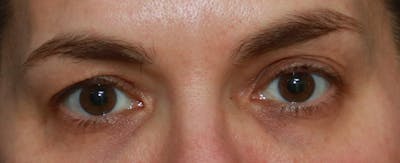Upper Blepharoplasty Before & After Gallery - Patient 32588701 - Image 1