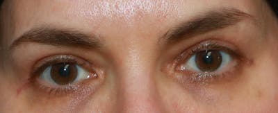 Upper Blepharoplasty Before & After Gallery - Patient 32588701 - Image 2