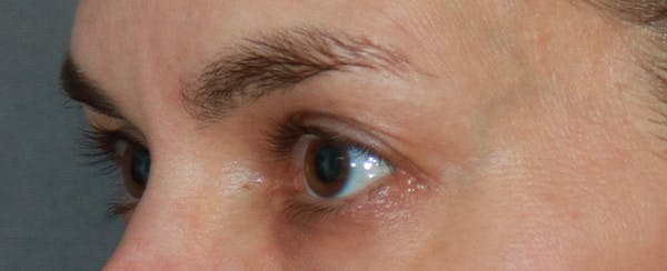 Upper Blepharoplasty Before & After Gallery - Patient 32588701 - Image 3