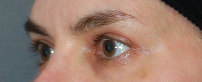 Upper Blepharoplasty Before & After Gallery - Patient 32588701 - Image 4