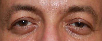 Upper Blepharoplasty Before & After Gallery - Patient 32588702 - Image 1
