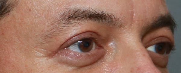 Upper Blepharoplasty Before & After Gallery - Patient 32588702 - Image 4