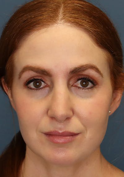 Aesthetic Rhinoplasty Before & After Gallery - Patient 35802290 - Image 2