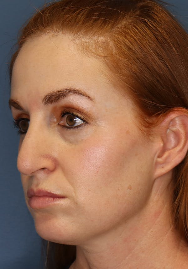 Aesthetic Rhinoplasty Before & After Gallery - Patient 35802290 - Image 3